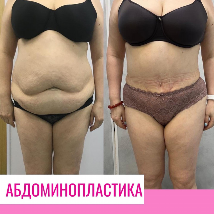 Сколько стоит липосакция живота в калининграде